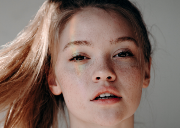 Young woman with freckles and hyperpigmentation