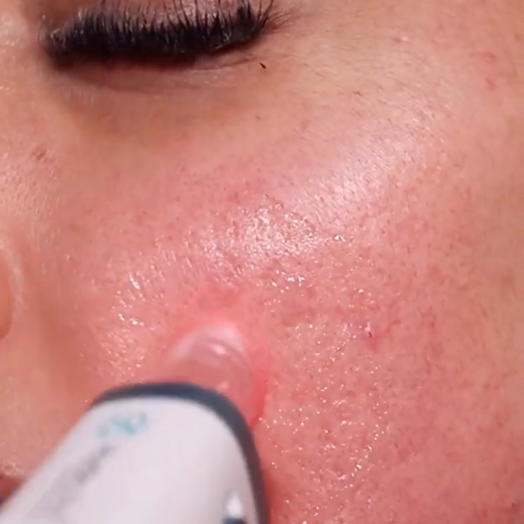 Hydra Pen H6 Bút Microneedling Thẩm Thấu Serum Nâng Cao với Liệu Pháp Ánh Sáng