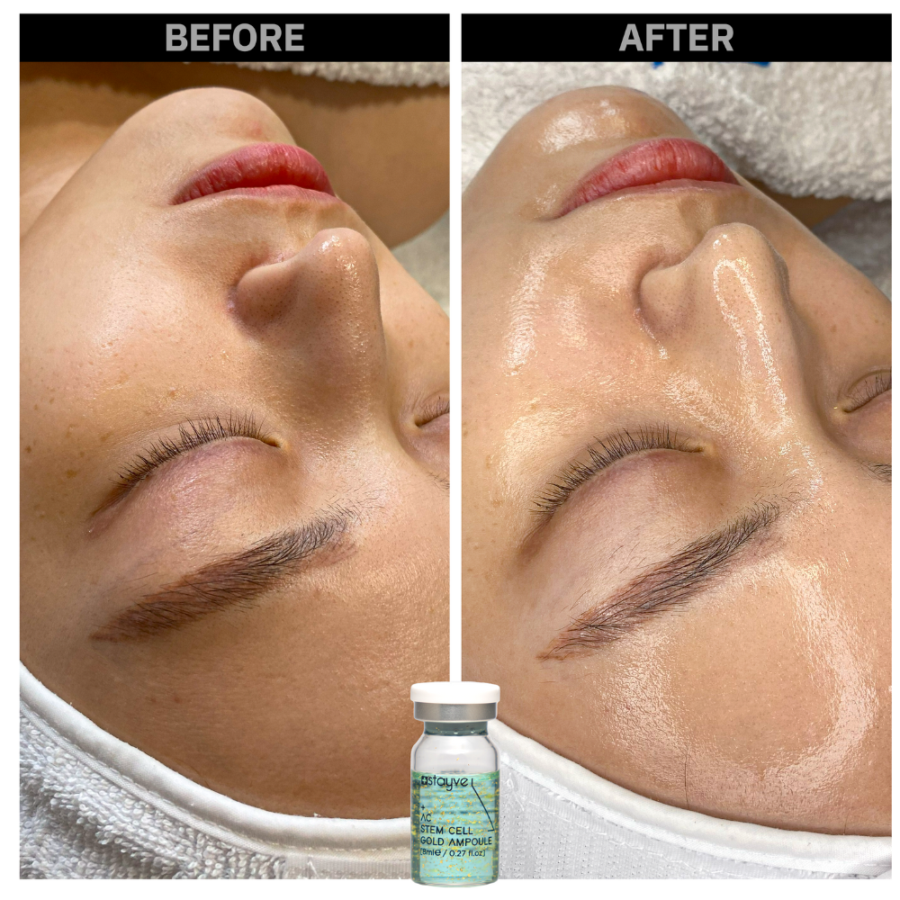 Before and after comparison of a woman's skin area after treatment with AC Stem Cell Gold Ampoule. Skin looks brighter, smaller pores, and more glowing.