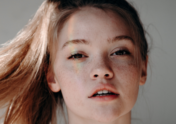 Young woman with freckles and hyperpigmentation 