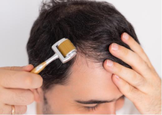 Man performing scalp microneedling at home with a derma roller for hair growth