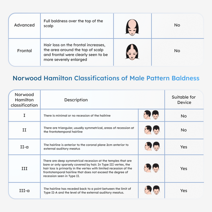2 tables in this image, one with Ludwig classifications for female pattern baldness, Second table detailing the Norwood Hamilton Classification of Male Pattern Baldness with illustrations 