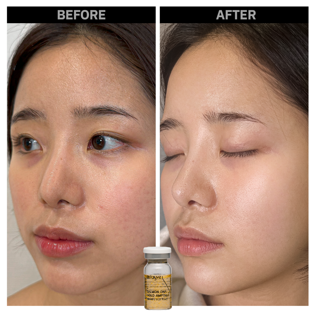 Before and after comparison of a woman's skin area after treatment with Salmon DNA Gold Ampoule. Skin looks brighter, smoother, smaller pores.